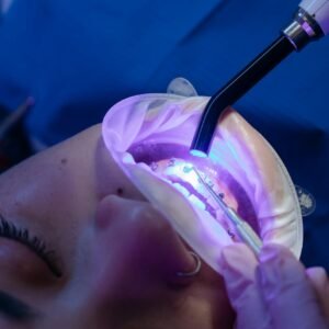 Close-up view of a dental procedure using LED curing light, enhancing oral health care.